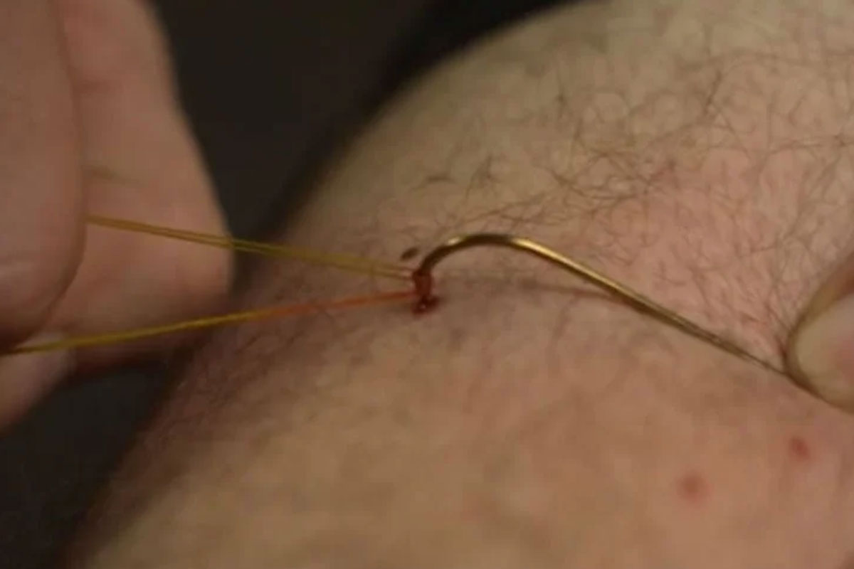 hook removal