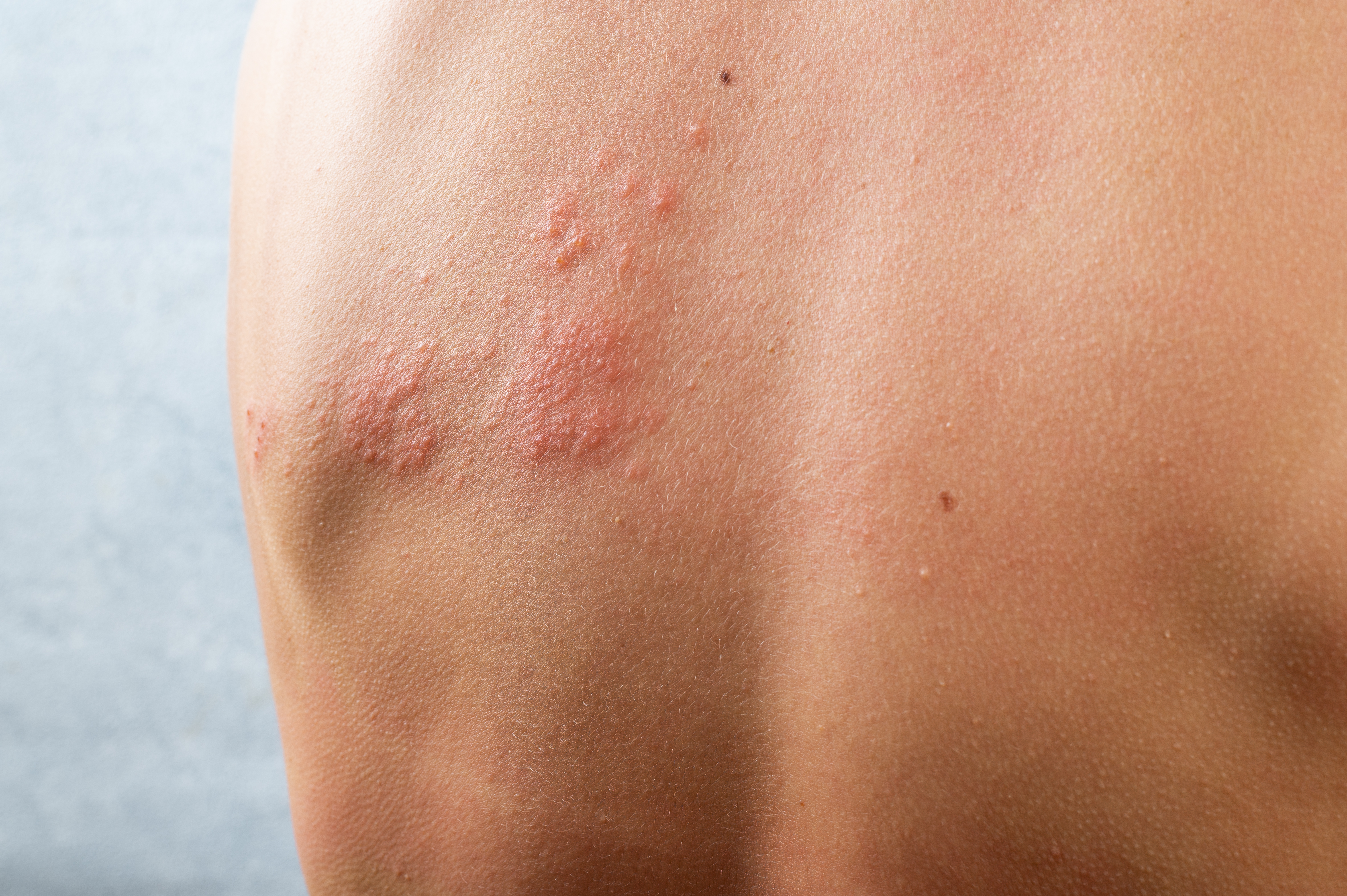 Skin infection rash poison ivy