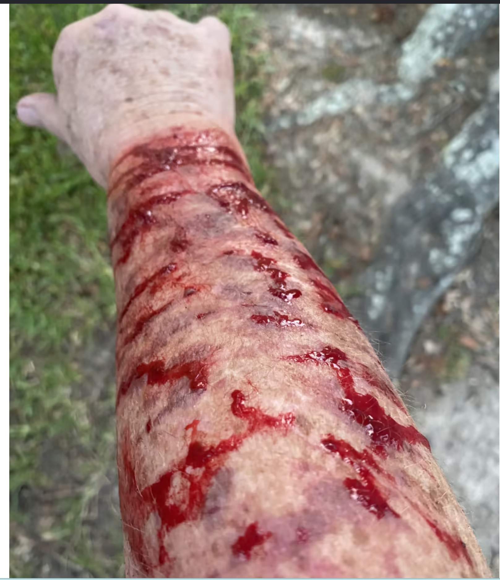 Peggy Jones shows the aftermath of her hawk attack. 