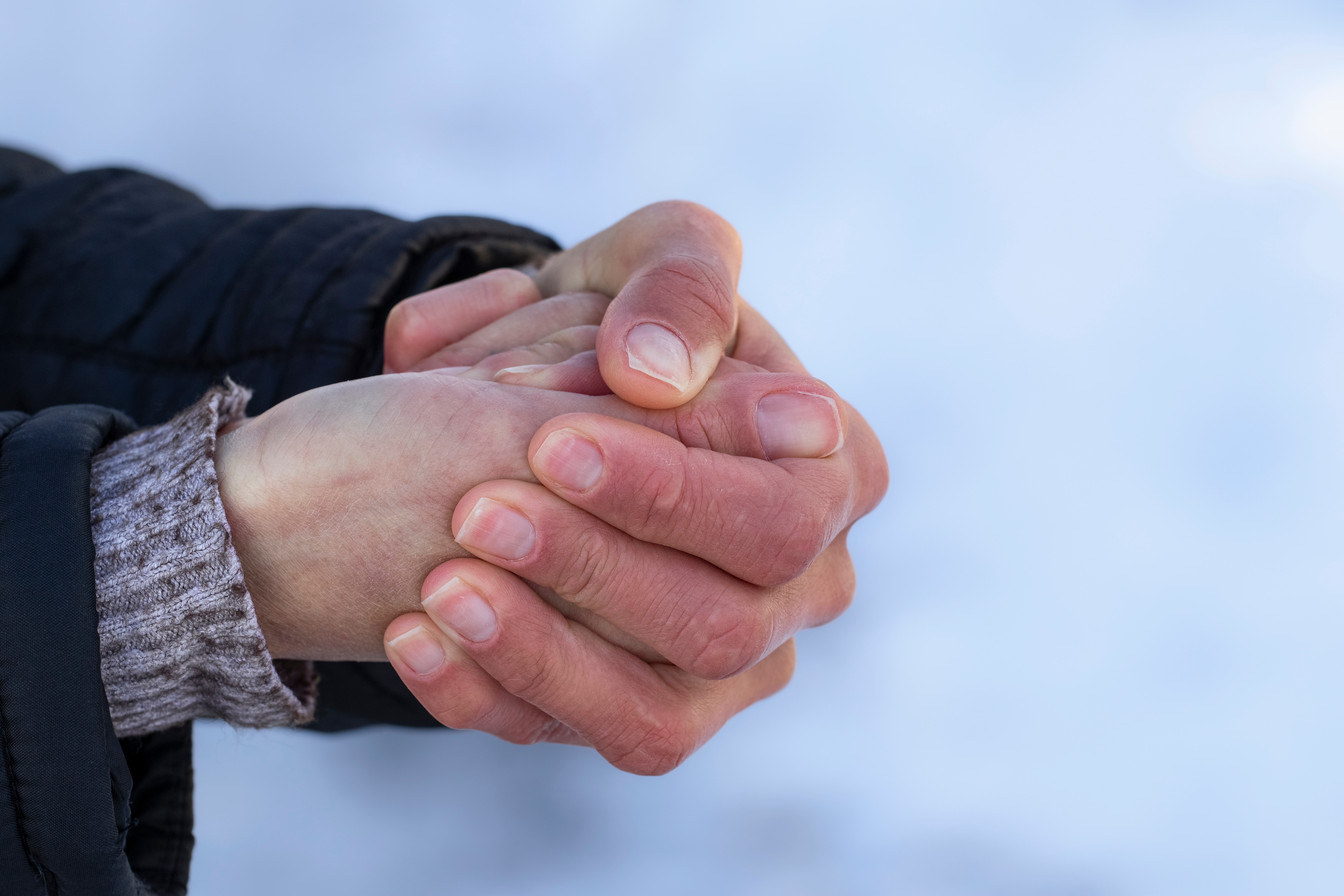 frostbite hands 