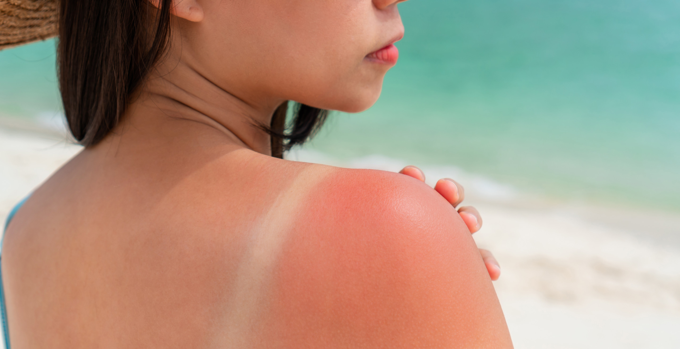 sunburn